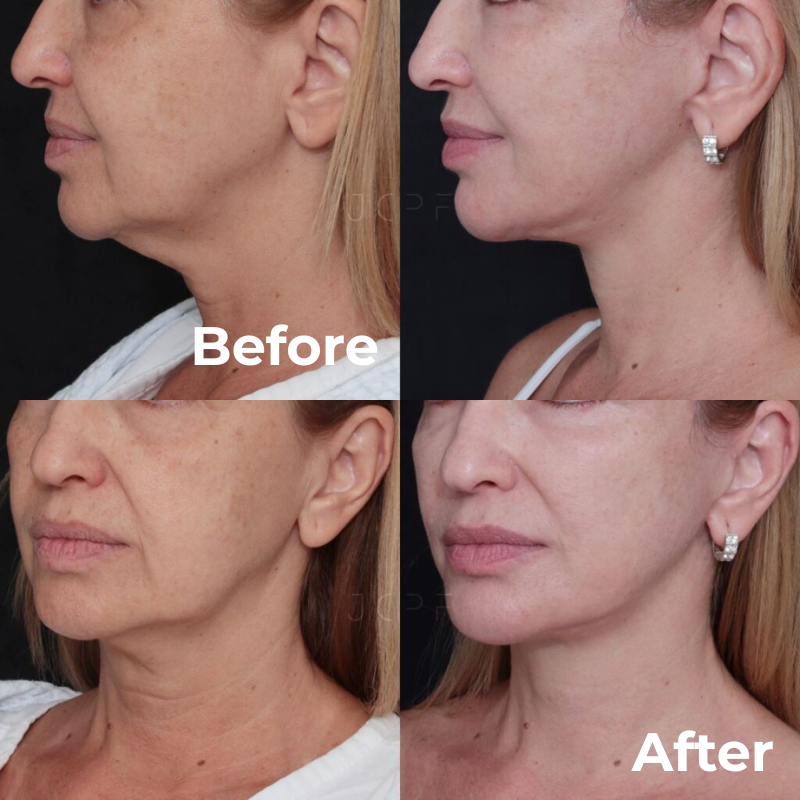 Buy 2 Get 1 Free Lifting Effect Tape Facial Care 5 Meters Anti-Wrinkle Tape  Free Shipping